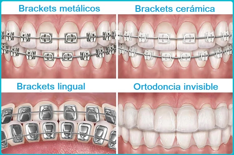 Tipos de Ortodoncia